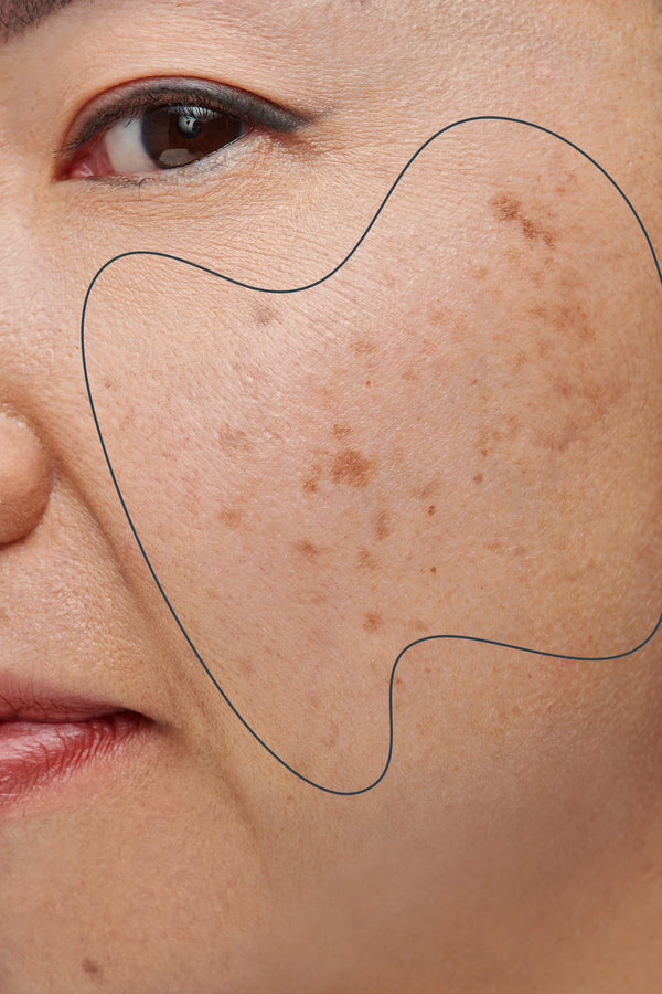 Dark Spots & Dullness