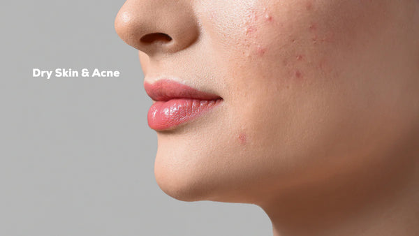 Acne & Acne Prone